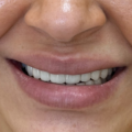 Smile Design Dental Clinic in Gurgaon for a Perfect Smile Makeover