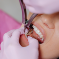 Dental Implants in Gurgaon: A Reliable Solution for Missing Teeth