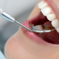 Dental Polishing Treatment Gurgaon: Benefits, Procedure & Cost