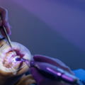 Root Canal Treatment in Gurgaon: Procedure, Benefits & Cost