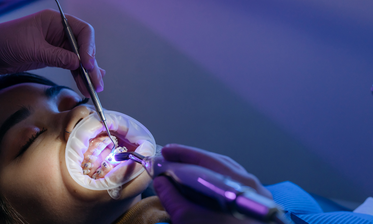 Root Canal Treatment in Gurgaon