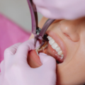 Root Canal Treatment in Gurgaon – A Guide to Saving Your Natural Tooth